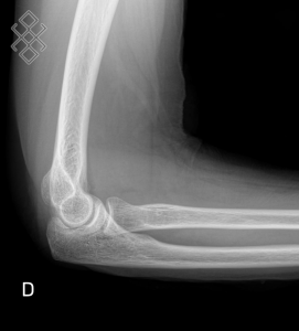 Radiographie du Coude