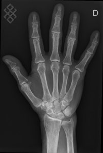 Radiographie de la Main