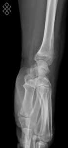 Radiographie du Poignet