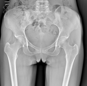 Radiographie du Bassin et Hanches