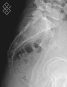 Radiographie du Sacrum