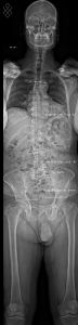 TéléRadiographie du Rachis en totalité