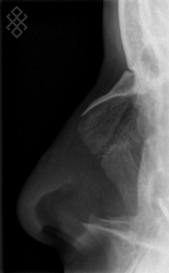 Radiographie des Os Propres du Nez (OPN)