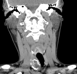 Scanner des Tissus Mous du Cou (cervico-facial)