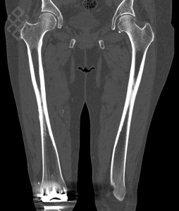 Scanner de la Cuisse (fémur)