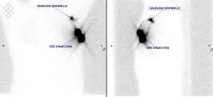 Lymphoscintigraphie (scintigraphie du ganglion sentinelle)