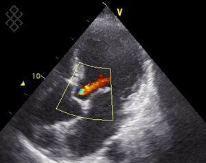 Échographie Cardiaque